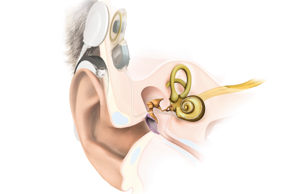 MED-EL kochlearinių implantų patikimumo ataskaita, balandis 2023