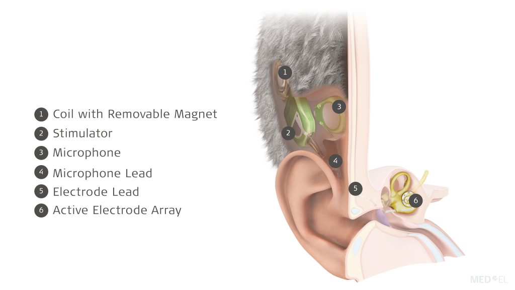 TICI UNICO visiškai nematomas kochlearinis implantas MED-EL“